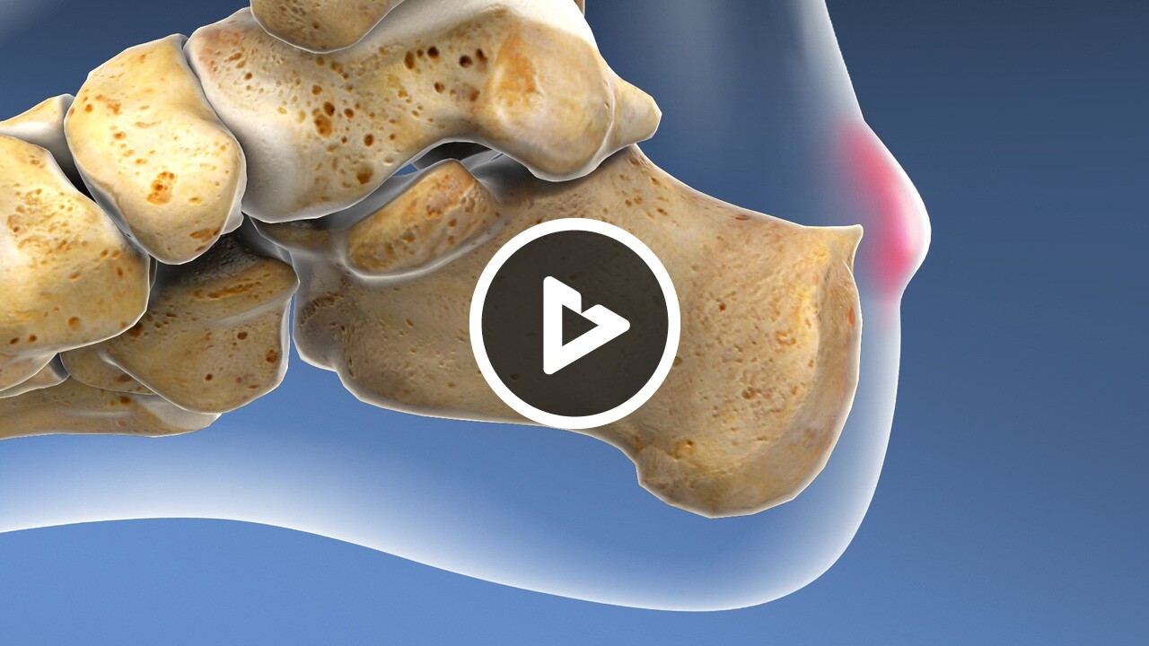 Haglunds Deformity Surgery Resection Method Foot And Ankle Willis Knighton Orthopedics 9423